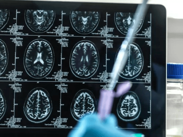 Ученые испытали новое лекарство от Альцгеймера. Оно замедляет развитие заболевания, если начать принимать его на ранней стадии — Nature